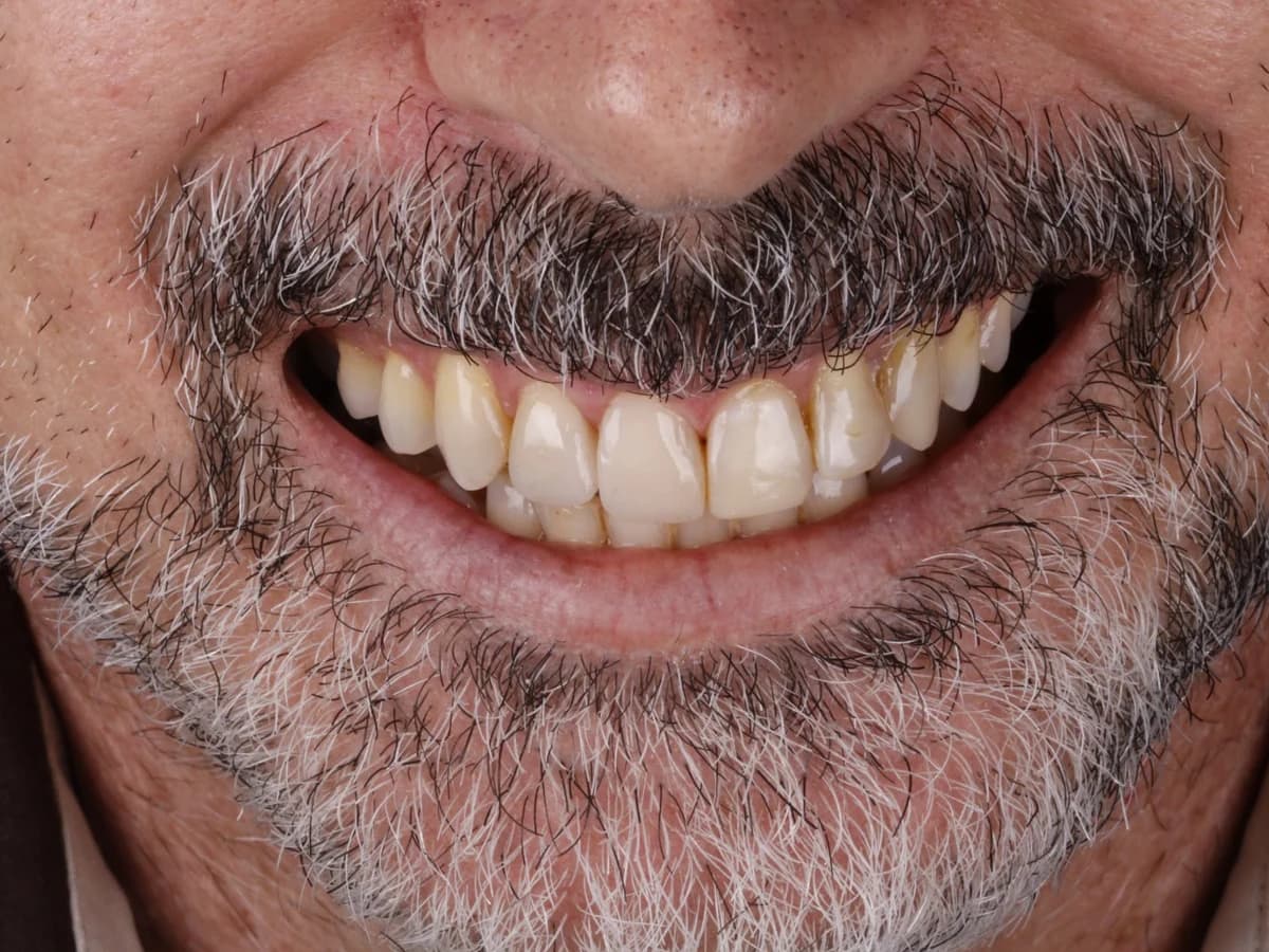 Reabilitação Estética — resultado depois do tratamento