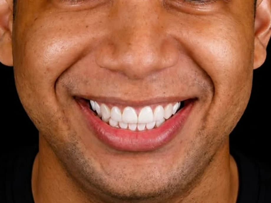 Transformação do Sorriso — resultado depois do tratamento