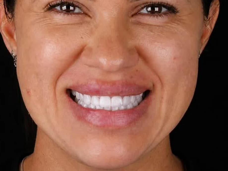 Transformação do Sorriso — resultado depois do tratamento