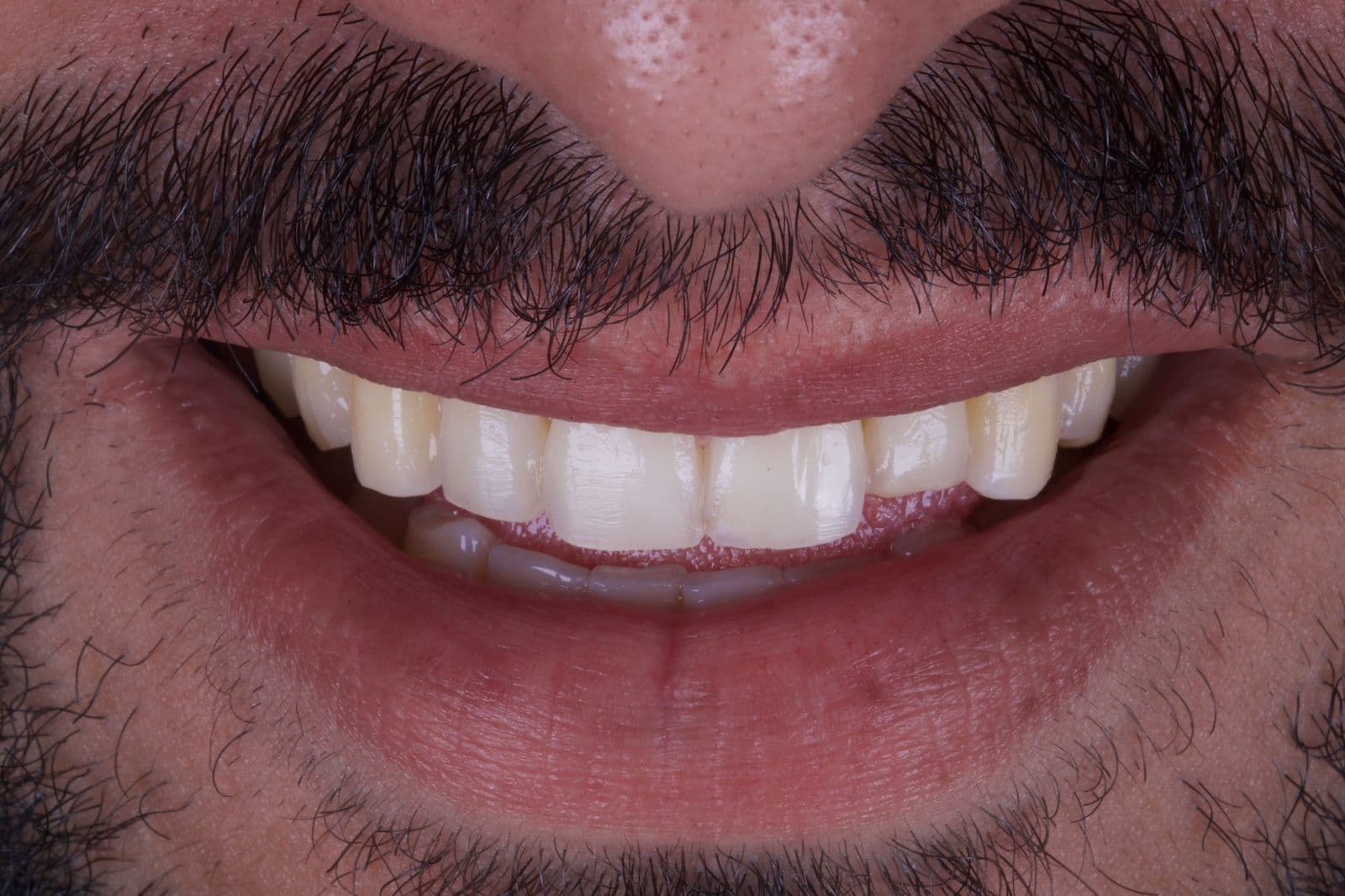 Antes