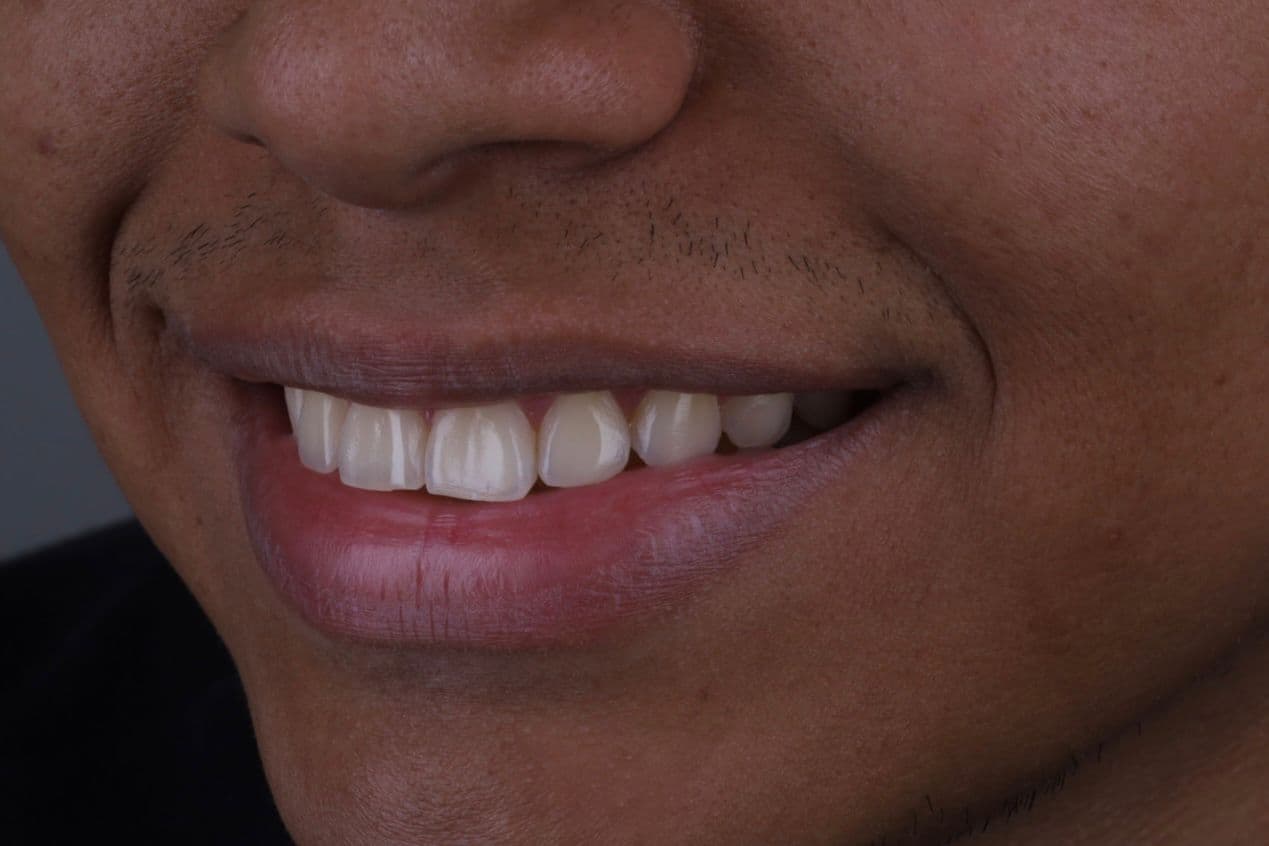 Antes