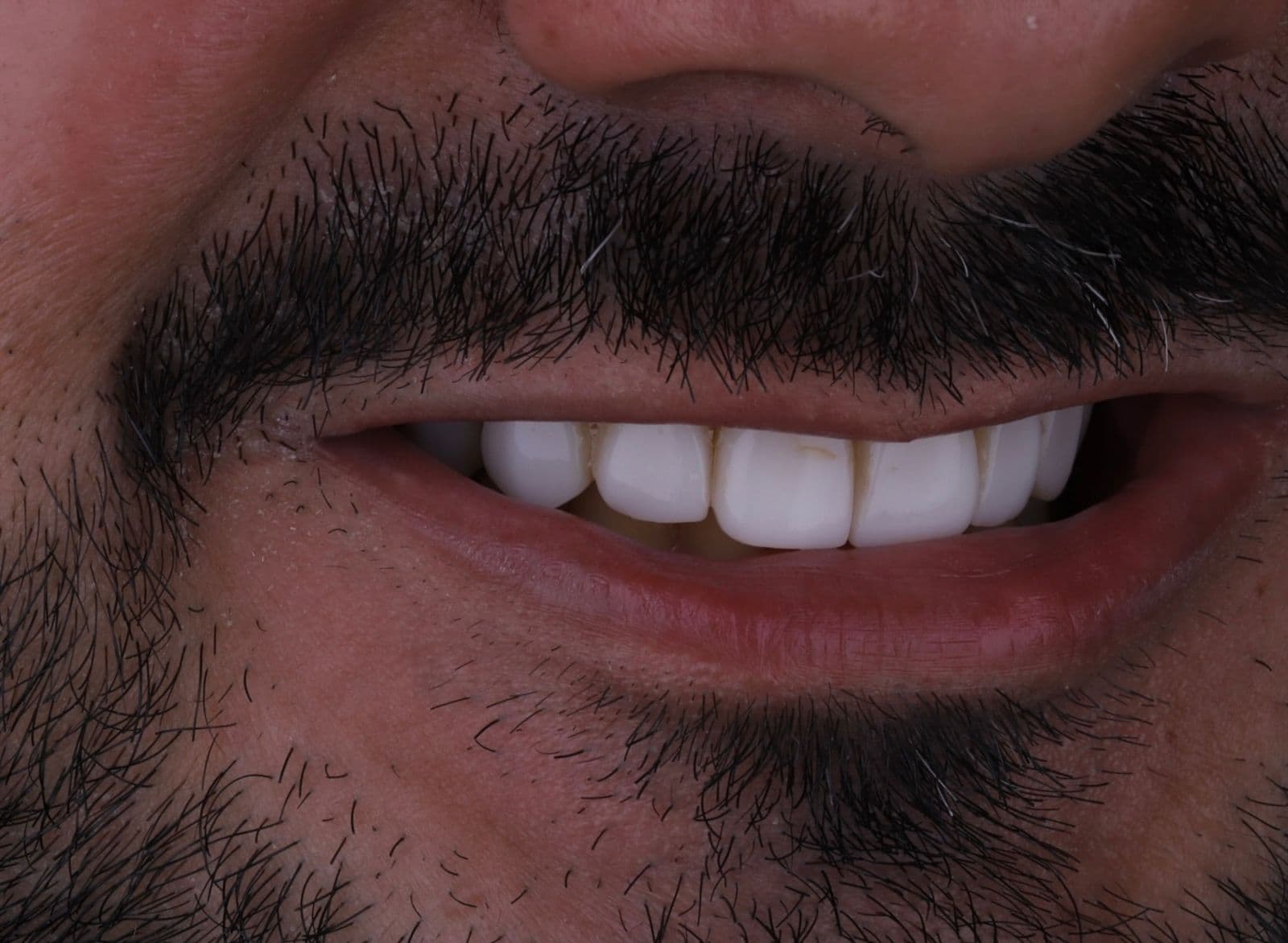 Antes