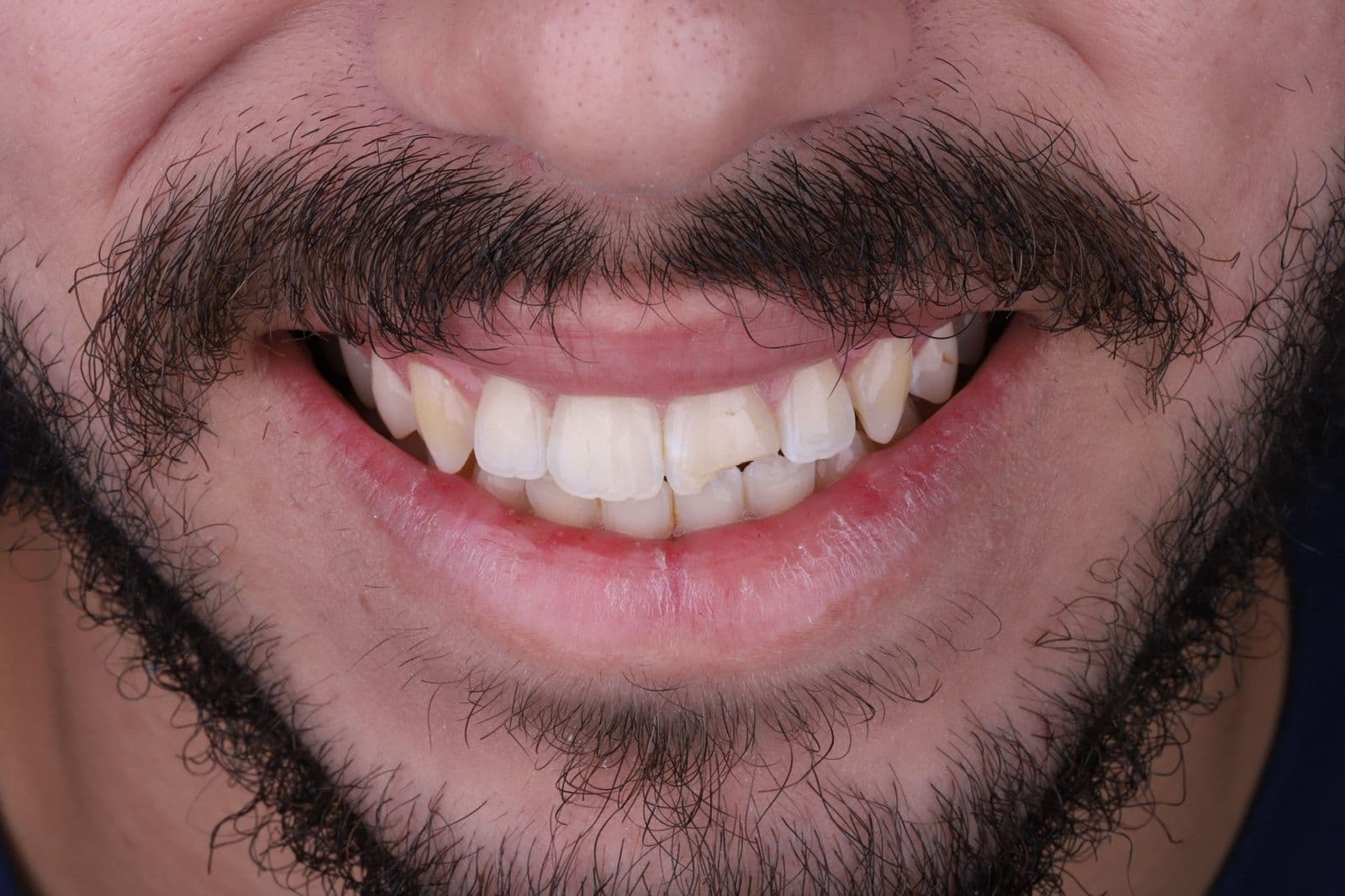 Antes
