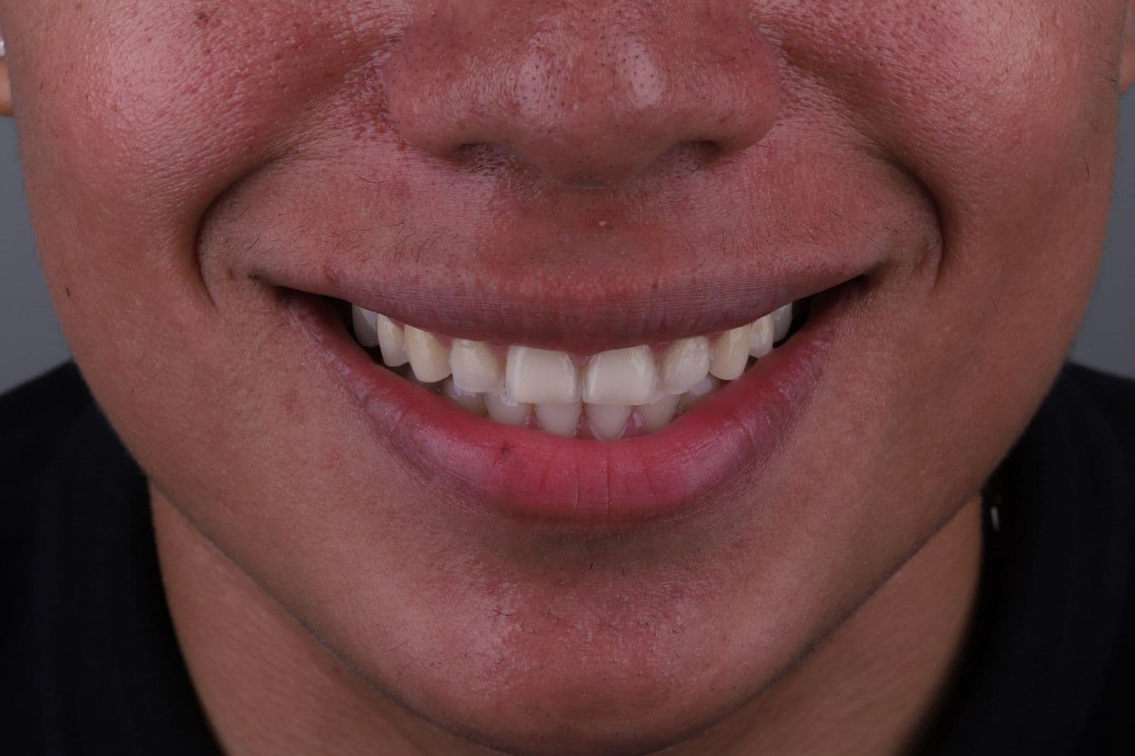 Antes