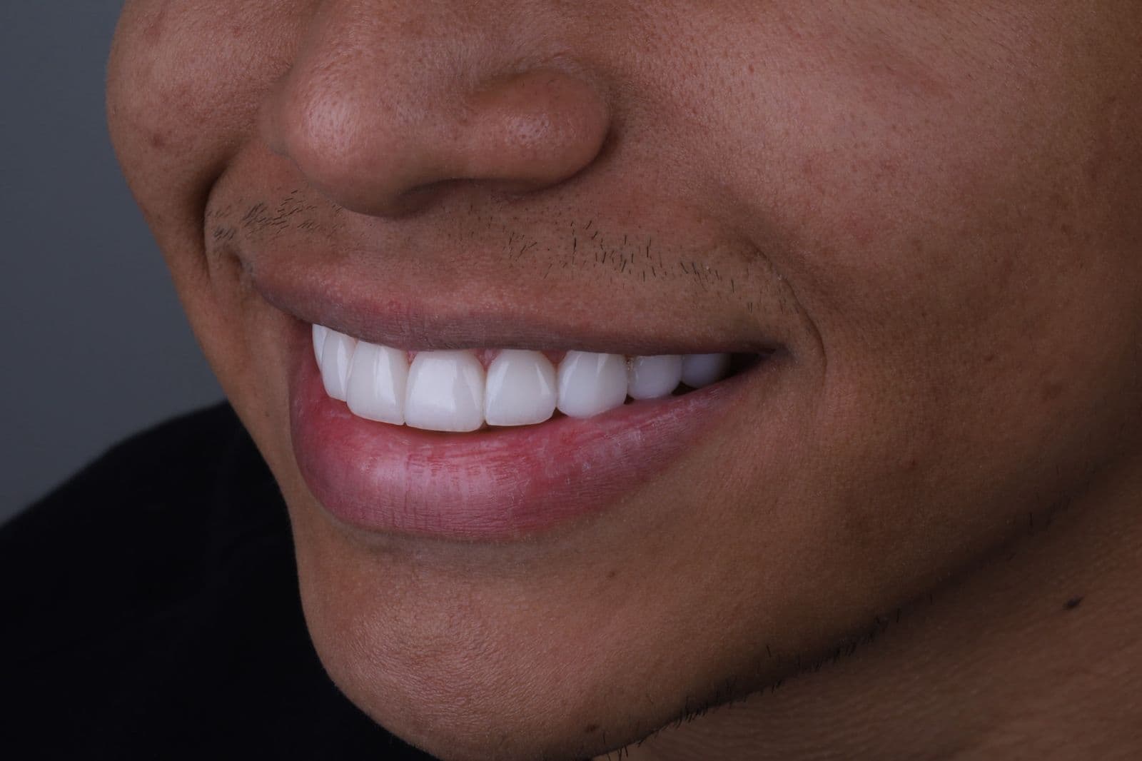 Lentes de Contato Dental