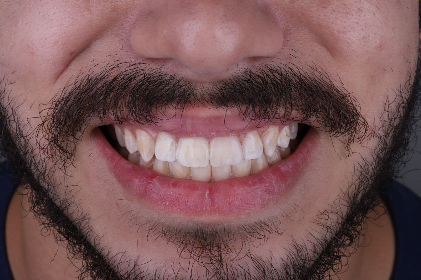 Design de Sorriso Digital